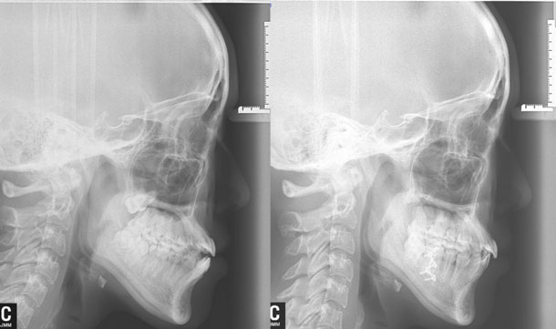横顔レントゲン写真　治療前（左）　後（右）