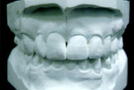 歯形模型